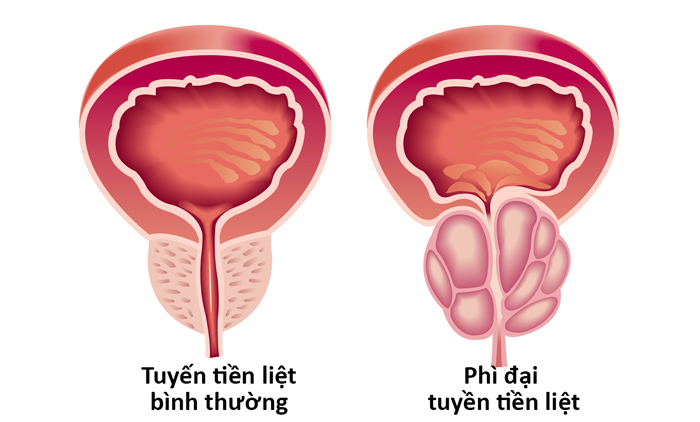 Nguyên nhân gây tiểu nhiều tia