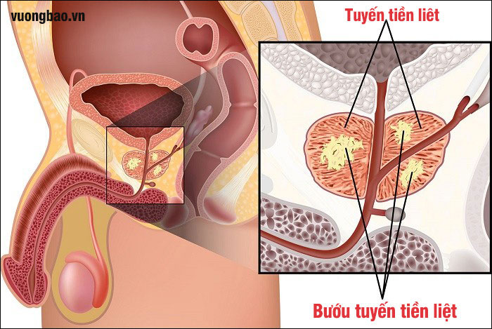 Bướu tuyến tiền liệt là gì? Nguyên nhân và cách chữa trị