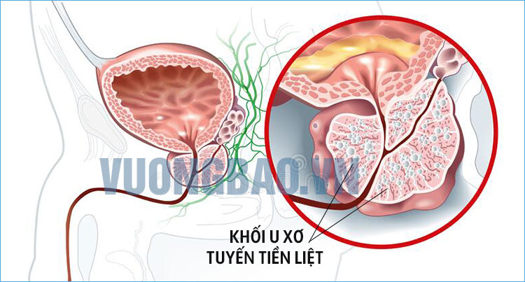 bị tiểu són phải làm sao