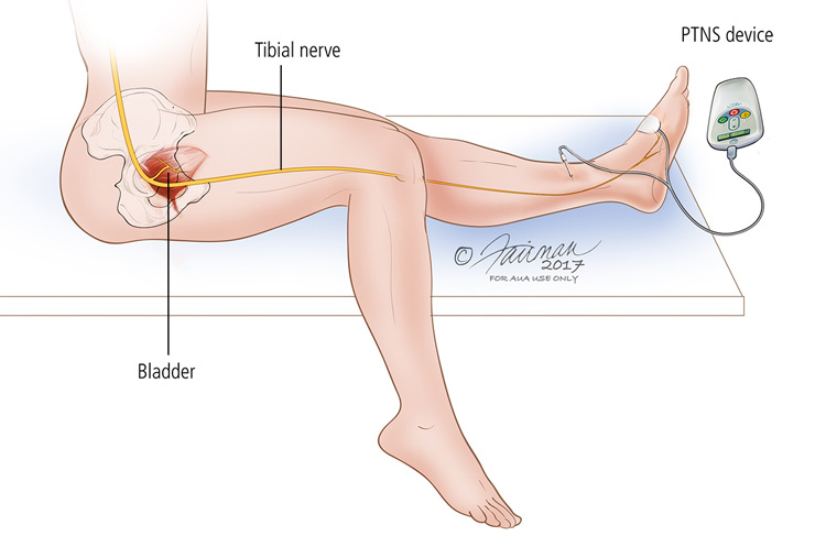 tiểu đêm ở người trẻ