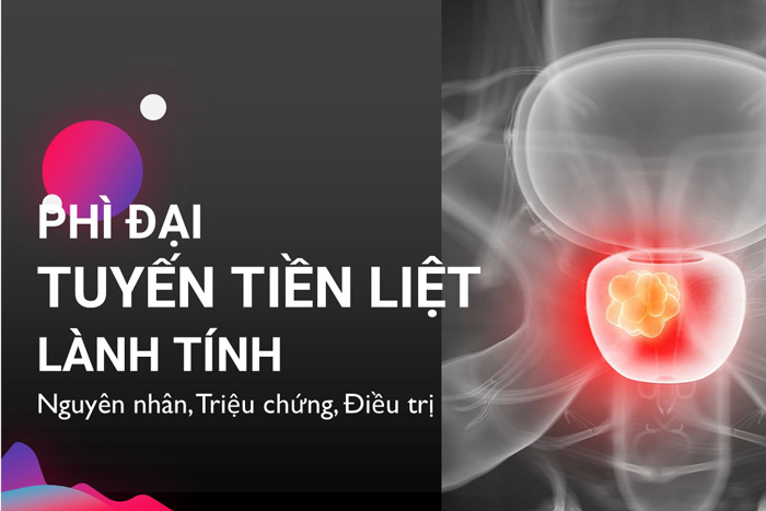 Phì đại tuyến tiền liệt lành tính: Nguyên nhân, triệu chứng, điều trị