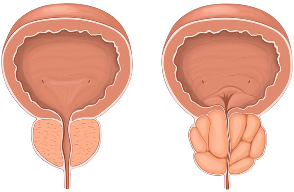 nguyên nhân gây u tuyến tiền liệt