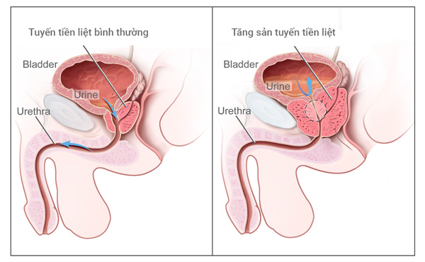 đi tiểu không hết