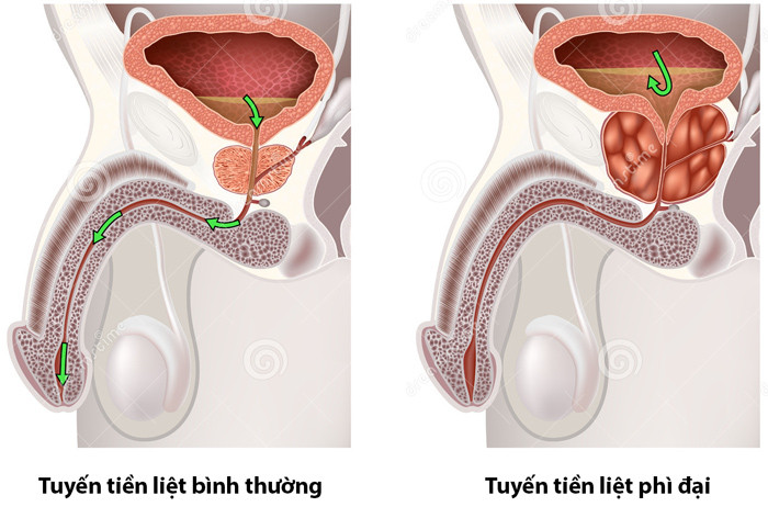 cảm giác mắc tiểu nhưng không tiểu được