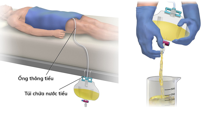 bí tiểu của đàn ông