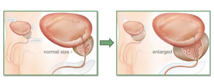 hiện tượng bí tiểu ở nam giới