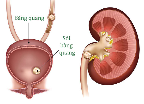 vôi hóa tuyến tiền liệt