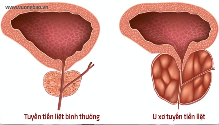 Vôi hóa tiền liệt tuyến