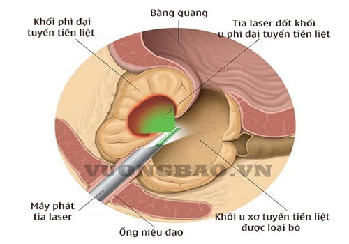 Mổ phì đại tuyến tiền liệt bằng laser - những điều cần biết