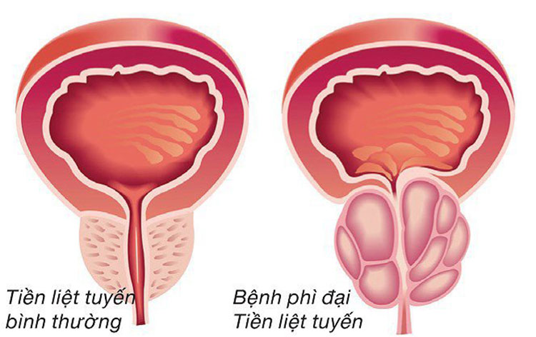 phi-dai-tuyen-tien-liet