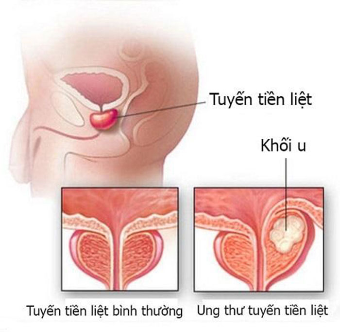 ung-thư-tuyến-tiền-liệt