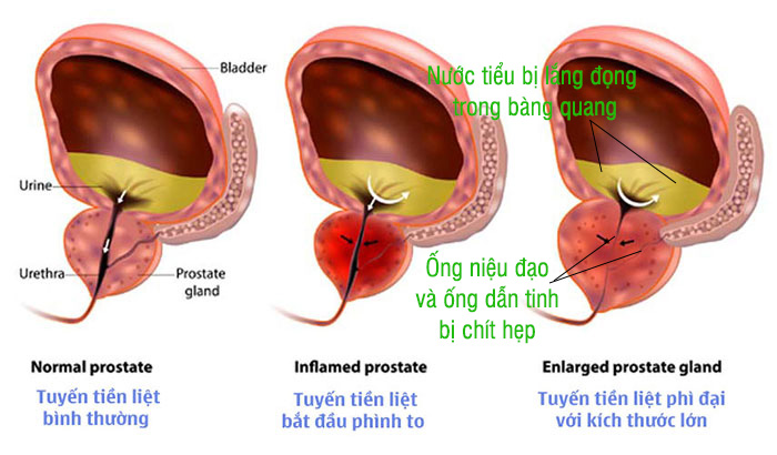 hình ảnh phì đại tuyến tiền liệt