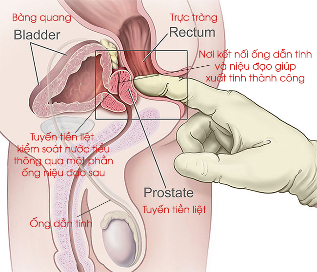 hình ảnh phì đại tuyến tiền liệt