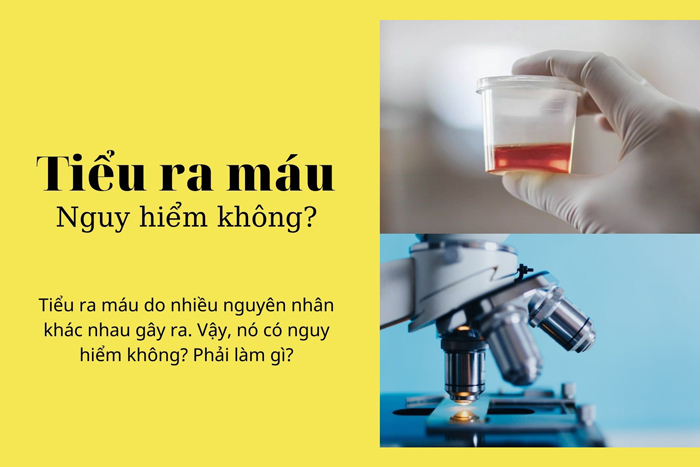 Tiểu ra máu có nguy hiểm không? Phải làm gì?