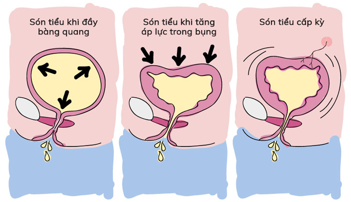 tiểu són la bệnh gì