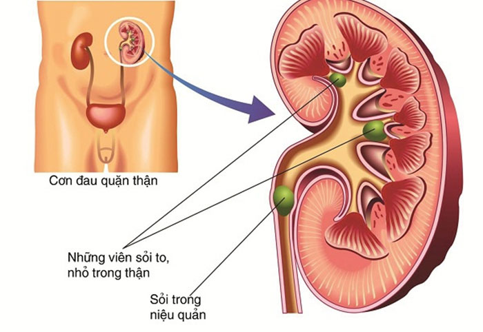 đi tiểu buốt ở nam