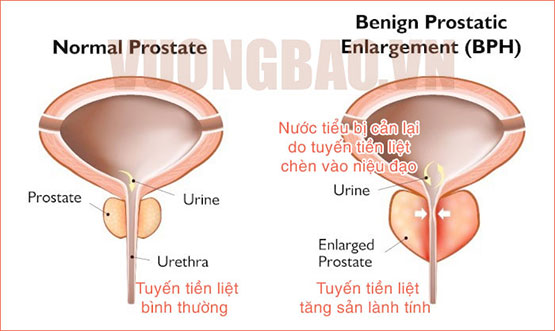 Tăng sản lành tính tuyến tiền liệt: Nguyên nhân & Cách chữa trị