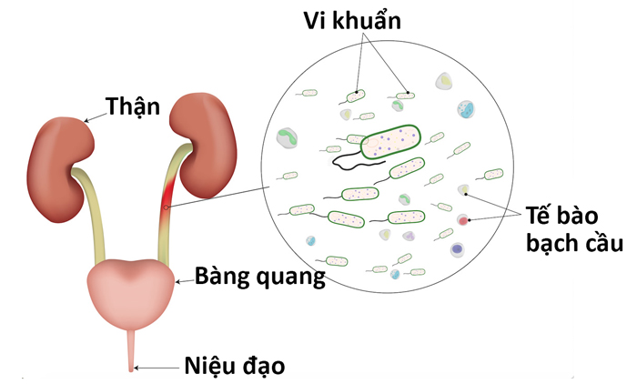 người già bị bí tiểu