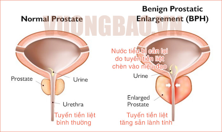 tăng sản tuyến tiền liệt lành tính