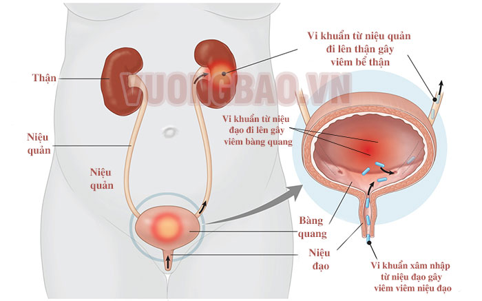 đi tiểu nhiều lần