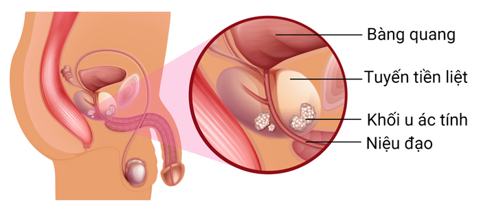 ung thư tiền liệt tuyến