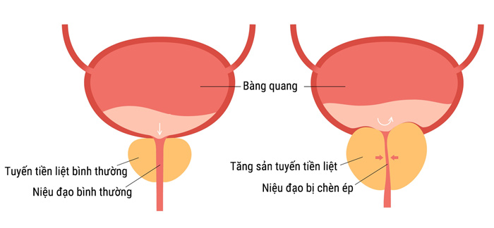 nước tiểu nhiều bọt