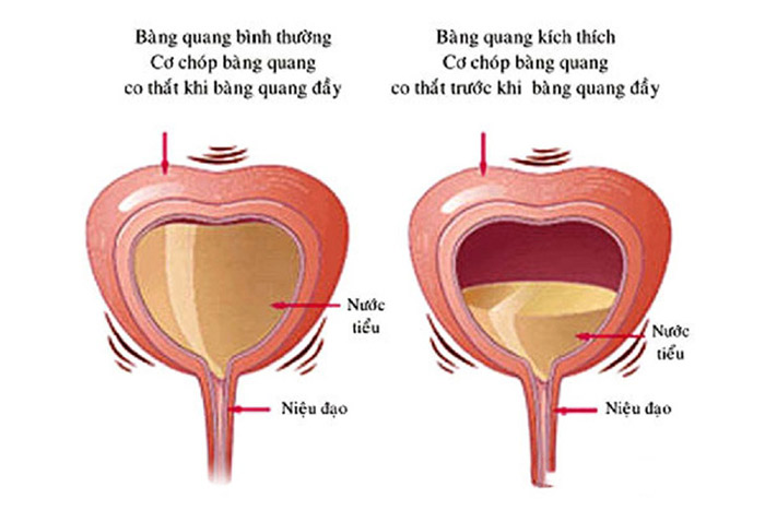 đi tiểu khó ở nam giới