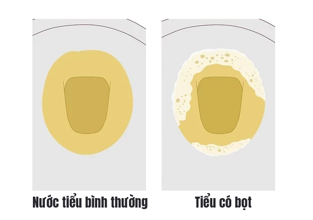 nước tiểu bình thường có bọt không