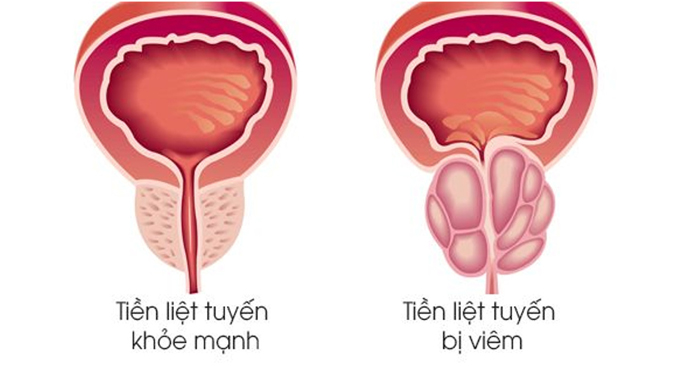 Kích thước tiền liệt tuyến