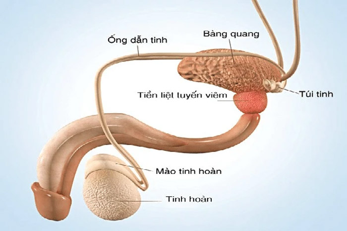 Sỏi tuyến tiền liệt