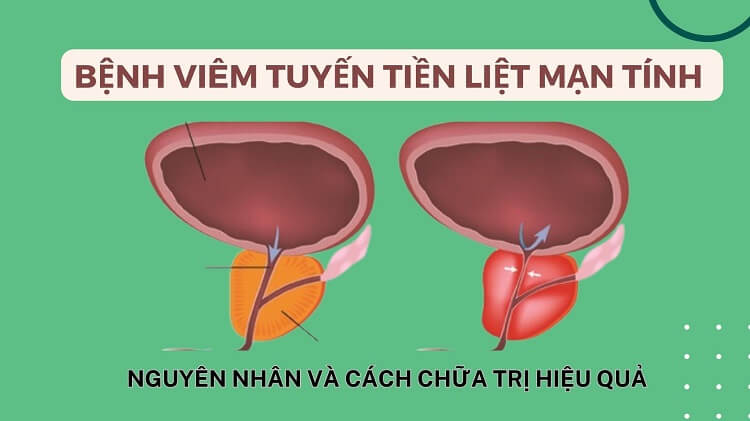 Bệnh viêm tuyến tiền liệt mãn tính có nguy hiểm không