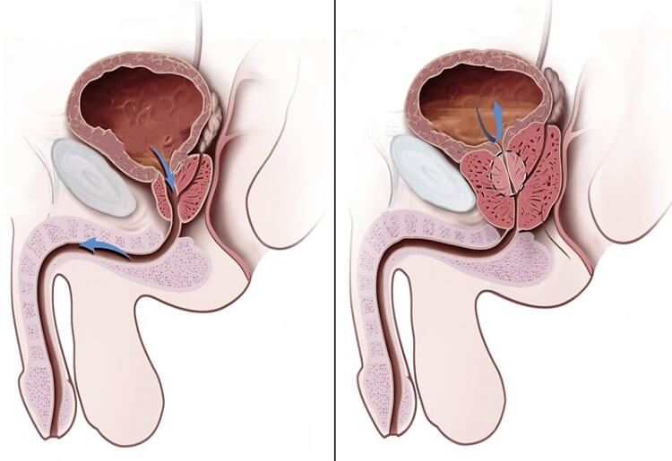 Bệnh viêm tuyến tiền liệt mãn tính ở nam giới
