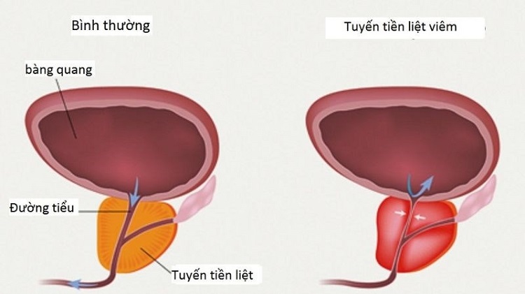 Hiện tượng Viêm tuyến tiền liệt ở nam giới