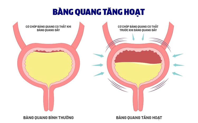 Bài tập giảm đi tiểu nhiều lần