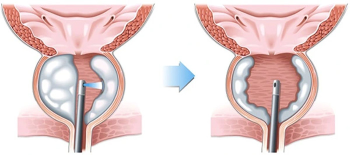 kích thước tuyến tiền liệt bao nhiêu cần mổ