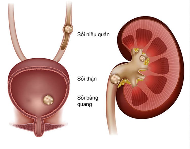 hiện tượng tiểu buốt tiểu rắt